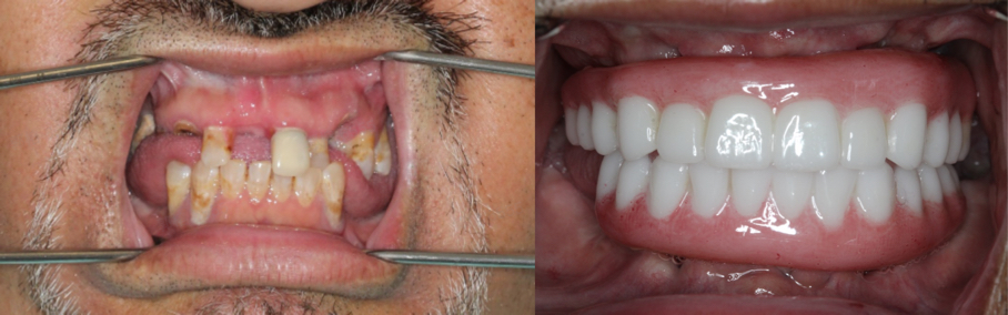 Patient Case Study | Dr. Jedediah Wooldridge Producing Full-arch Dentures